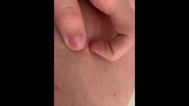 Naked Pimple Popping Pornhub