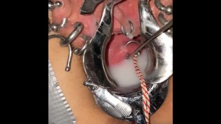 The Cervix Is Extremely Loud