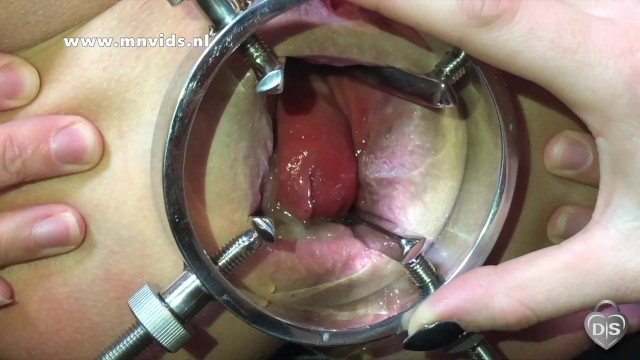 Anal gaping with an anal spreader