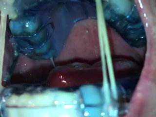 Self Facial Cumming On Braces Retainer Twinblock With Headgear