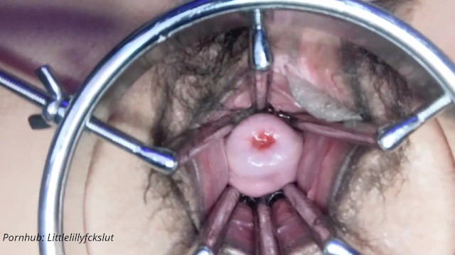 Cervical Fisting - First Insertion: the Extremity Dildo. Spreader Pussy Held Wide Open. Cervix  Showing. Speculum. - Pornhub.com
