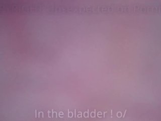 Urethra Bladder Insertion With Diy Endoscope - Amateur