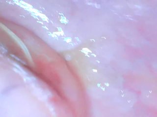 Endoscope Cervix Exploration (Camera InsideVagina)