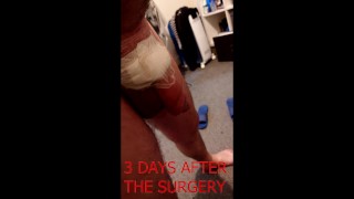 Big Cock Penile Girth And Length Surgery 8495