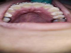 Exploring my mouth with braces (in the dentist)